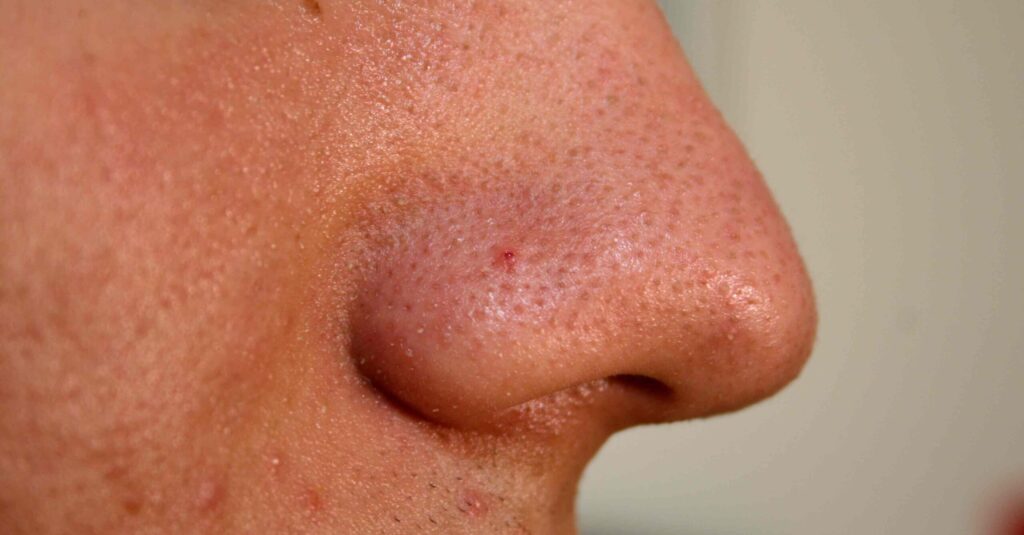 नाक पर ब्लैकहेड्स हटाने के उपाय